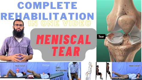 test for meniscus tear youtube|how to determine meniscus tear.